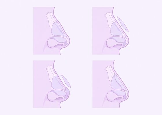 연골 이식 단계 개념 일러스트 (AI 생성 예시)
