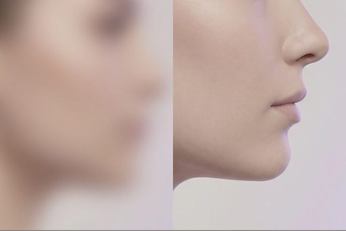 무보형물 코성형 개선 방향 개념 이미지 — 실제 환자가 아닌 AI 생성 개념 예시