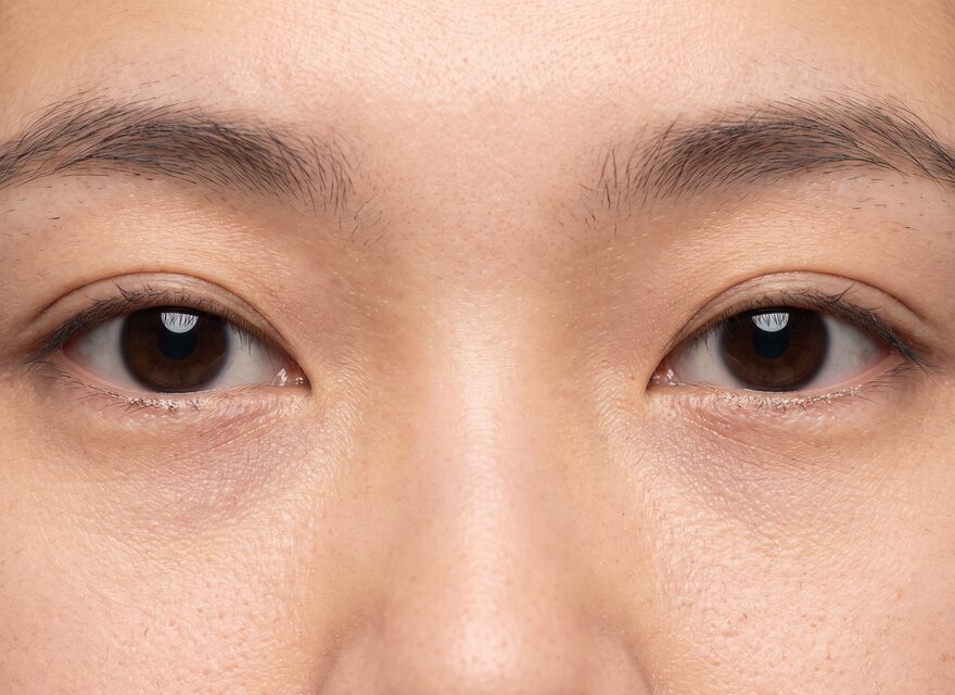 쌍꺼풀 재수술 후기 – 눈가 비식별 개념 예시 이미지
