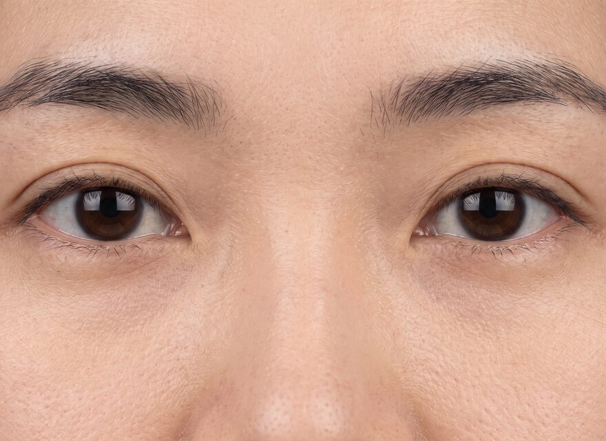 눈밑꺼짐 눈밑지방재배치 후기 – 눈가 비식별 개념 예시 이미지