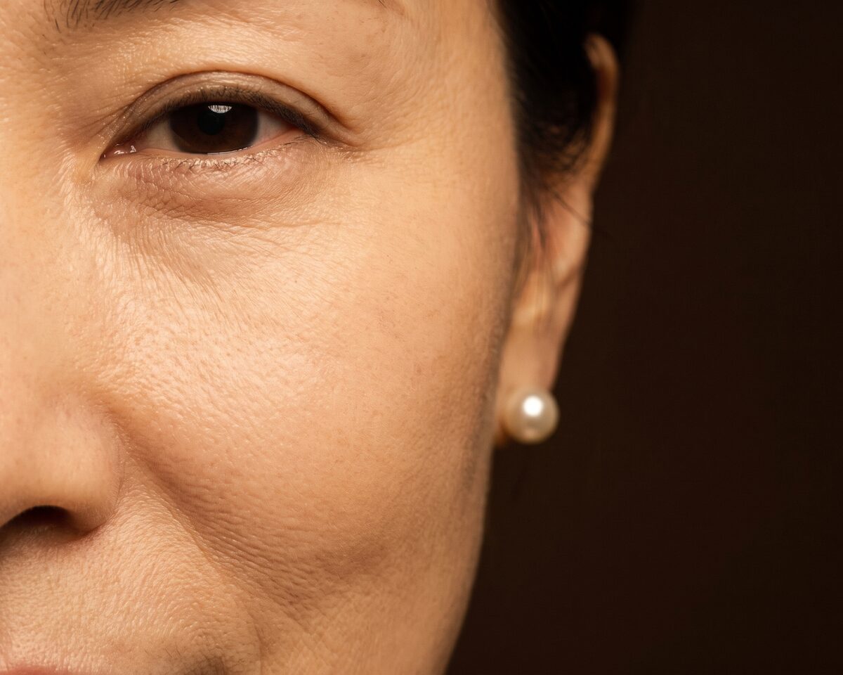 눈밑지방 재배치 이벤트 이미지 — 눈밑 라인이 보이는 근접 컷