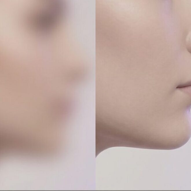 귀 앞 절개 라인을 가는 봉합 표식으로 마무리한 옆얼굴 일러스트