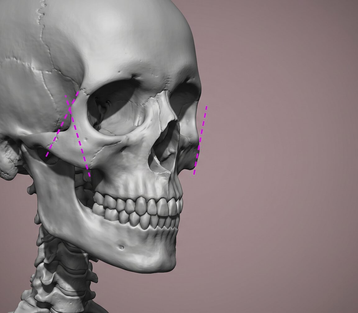 3D 렌더 느낌의 두개골 해부도 — 광대활 앞·뒤 절골 예정선 표시