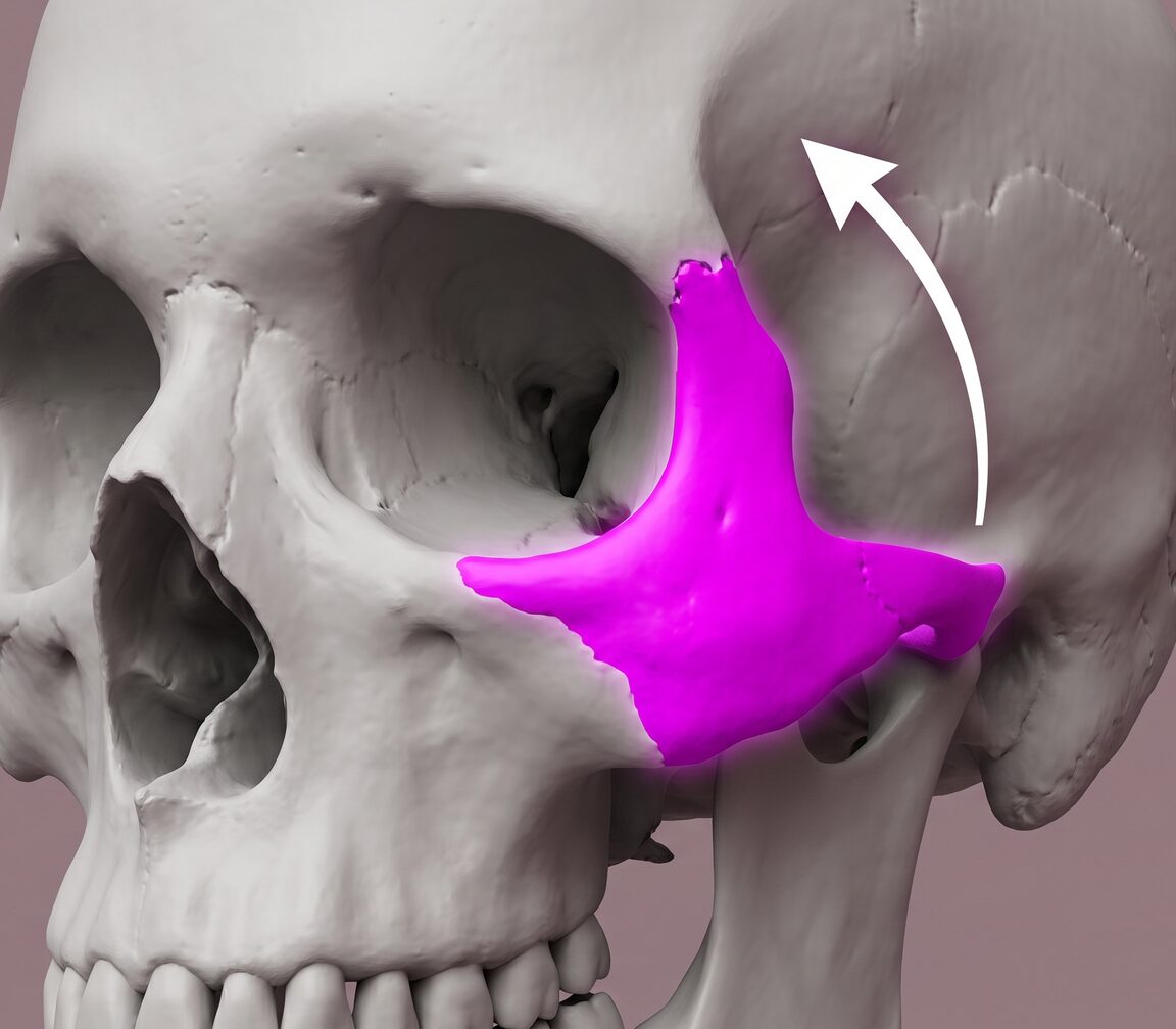 3D 렌더 느낌의 두개골 해부도 — 분리된 광대 조각의 회전·이동 방향 표시