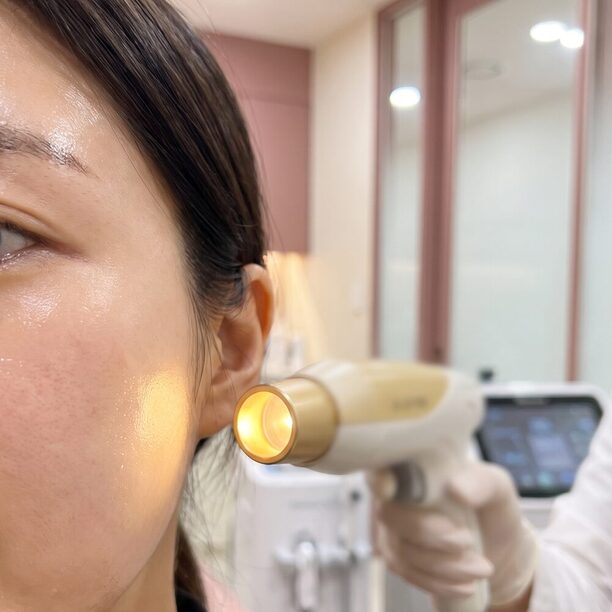 하부 미니거상 1단계 — 귀 앞쪽 접근 경로를 가는 선으로 표시한 측면 얼굴 일러스트