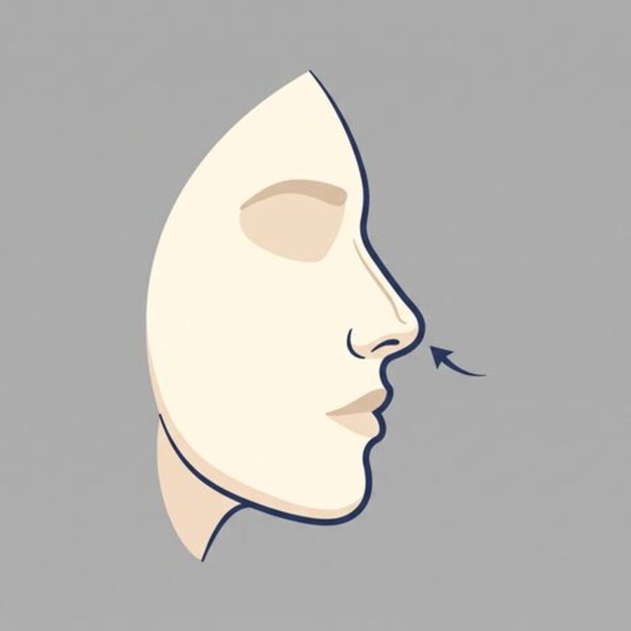 코끝 연골이 벌어져 넓게 퍼진 상태를 보여주는 측면 일러스트